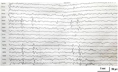 Complex Mosaicism of Two Distinct Mutations in a Female Patient With KCNA2-Related Encephalopathy: A Case Report